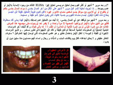 مرض الايدز واعراضه بالصور