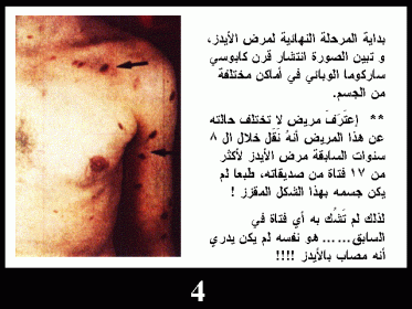 مرض الايدز واعراضه بالصور