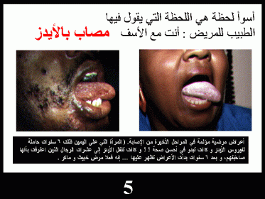 مرض الايدز واعراضه بالصور
