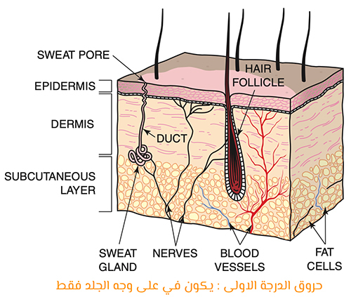 اضغط على الصورة لعرض أكبر الاسم: First-degree-burn.jpg?resize=500%2C423&amp;ssl=1.jpg الحجم: 175.7 كيلوبايت رقم التعريف: 225712