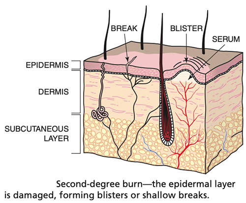 اضغط على الصورة لعرض أكبر الاسم: Second-degree-burn.jpg?resize=500%2C412&amp;ssl=1.jpg الحجم: 60.3 كيلوبايت رقم التعريف: 225713