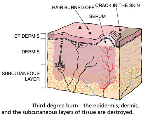 اضغط على الصورة لعرض أكبر الاسم: Third-degree-burn.jpg?resize=500%2C401&amp;ssl=1.jpg الحجم: 56.3 كيلوبايت رقم التعريف: 225714